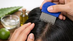 Cara menghilangkan kutu rambut dan telurnya di rumah, lengkap jadwal ulang hari ke-7–10